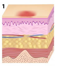 stage 1 pressure ulcer illustration