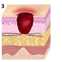 pressure ulcer stage 3 illustration